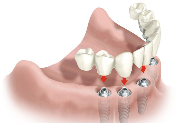 имплантация зубов воронеж